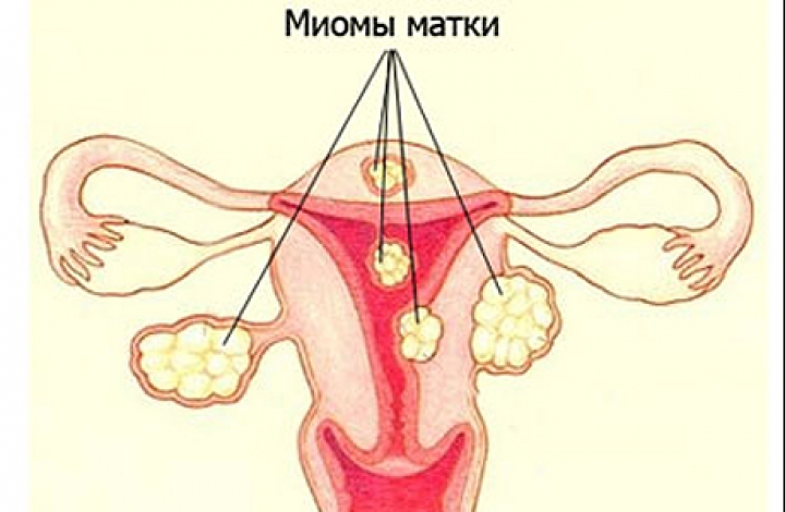 Цистоэктомия. Интрамуральная лейомиома матки. Миомы и фибромиомы матки.