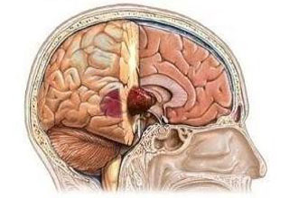 ﻿Опухоль головного мозга
