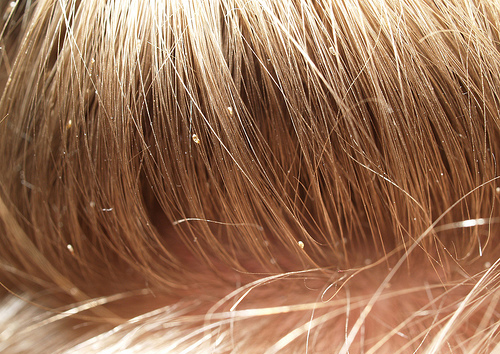 10. The Difference Between Lice and Nits in Blonde Hair - wide 4