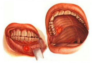 Причины воспаления полости рта