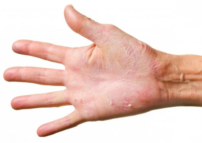 Шелушение кожи — болезни, сопровождающиеся шелушением кожи